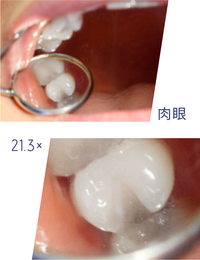 虫歯の早期発見・早期治療が大切です