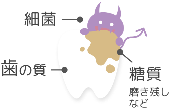虫歯ができる原因は?
